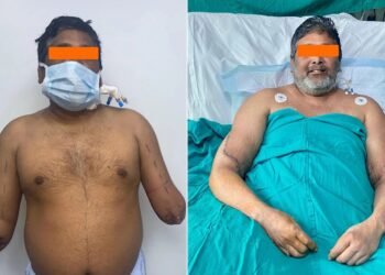 Delhi Painter Gets Hands Back in Mind-Blowing Surgical Operation