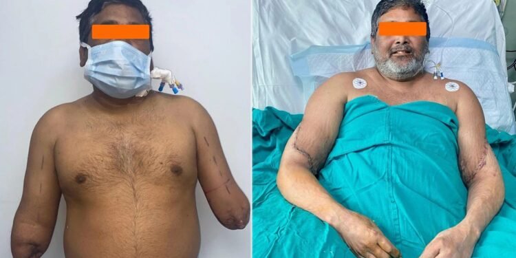 Delhi Painter Gets Hands Back in Mind-Blowing Surgical Operation